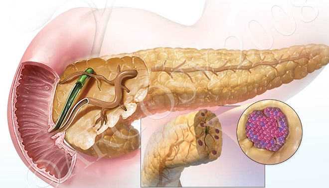 A magas inzulintermelés hasnyálmirigyrákhoz vezethet